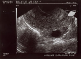 Transvaginal ultrasound of ovary and follicle