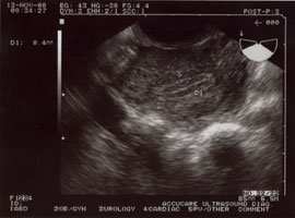 Transvaginal ultrasound of uterine lining